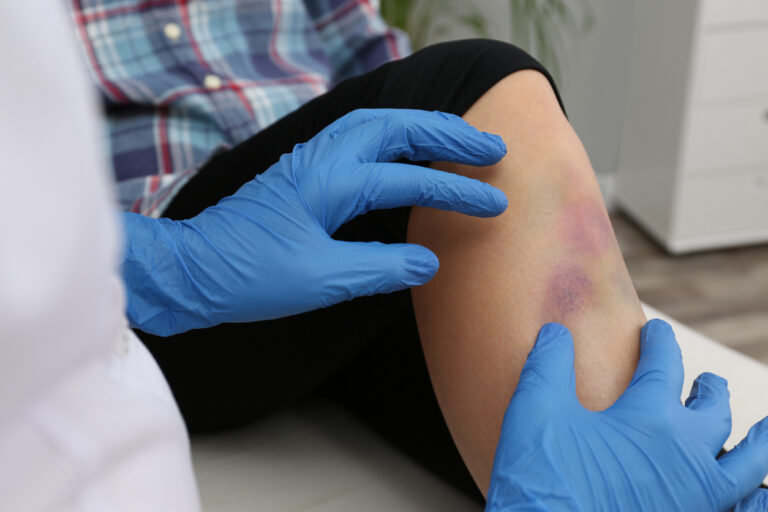 Healthcare provider examining bruising on a patient’s leg, illustrating a soft tissue injury after a car accident